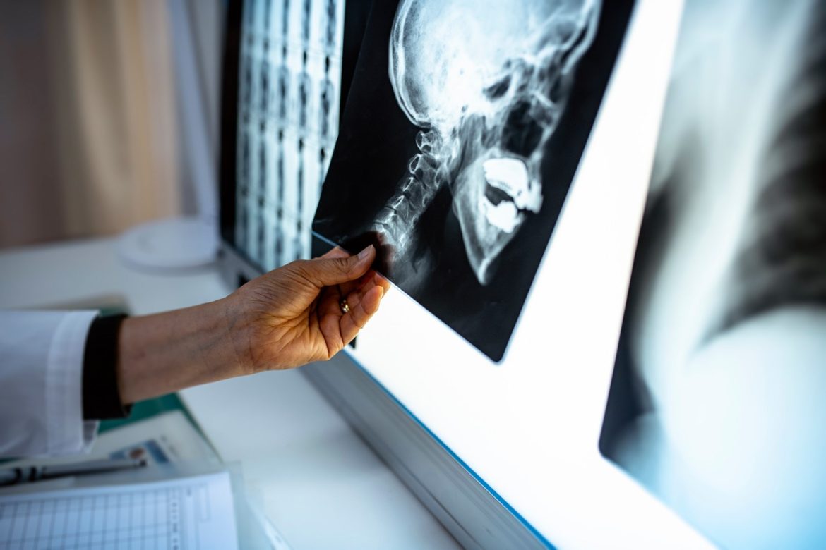 A setback to research that offered hope for fibrous dysplasia patients