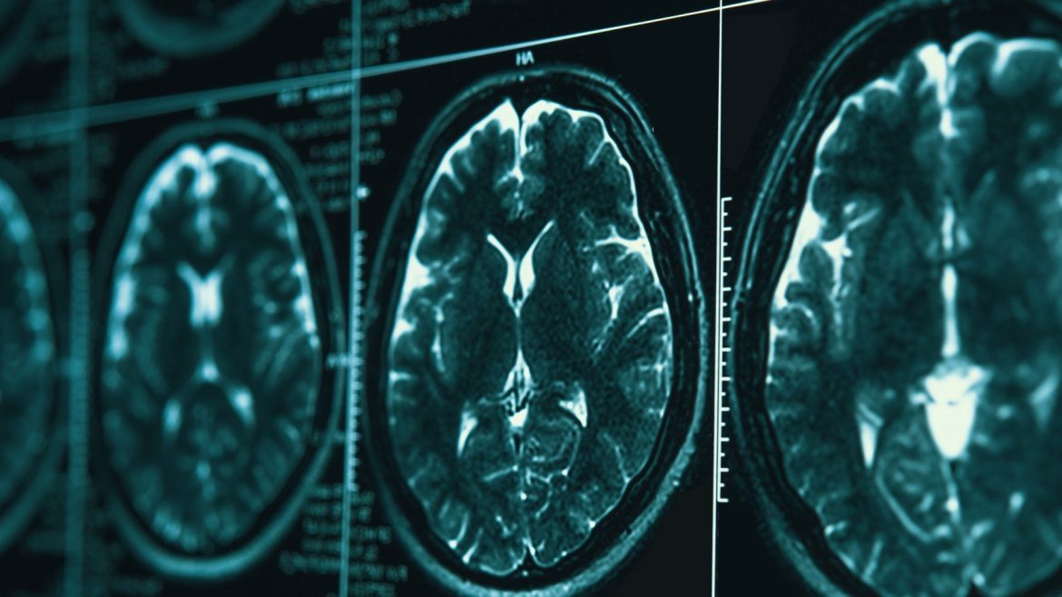 Making real gains in war on Alzheimer’s
